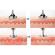 Aparat Fibroblast Plasma Pen Indepartarea Cicatrici, Petelor, Alunitelor, Pistruilor, Lifting Pleoape Facial, Antiacnee Mole Removal Bat
